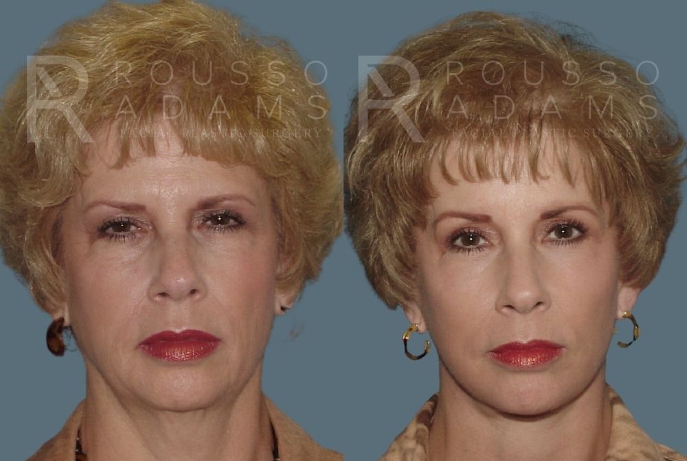 Facelift - Dr. Rousso Before & After Gallery - Patient 147375107 - Image 3