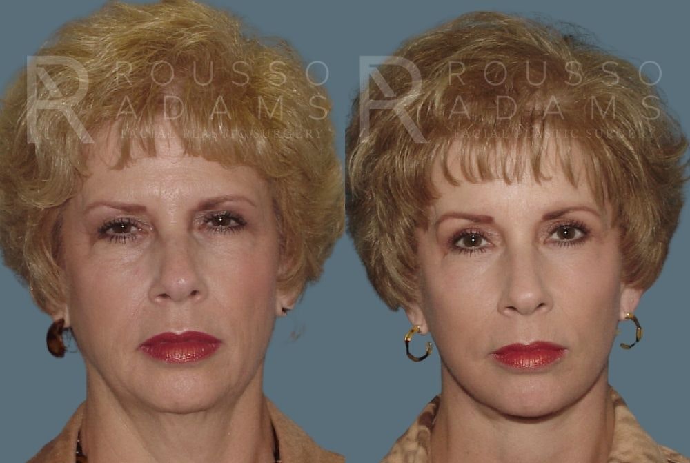 Facelift <span class=small>By Dr. Daniel Rousso</span> Before & After Gallery - Patient 147375107 - Image 3