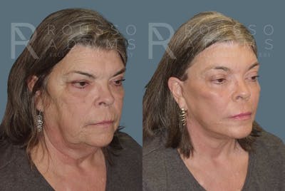 Facelift Before & After Gallery - Patient 147375108 - Image 1