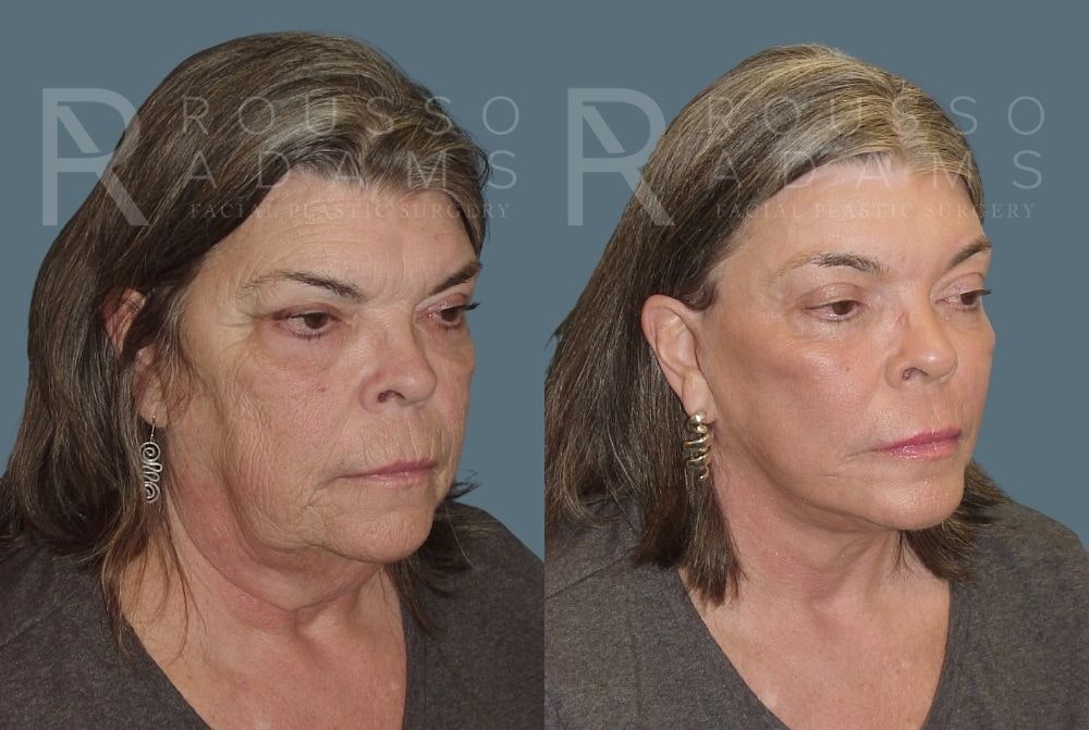 Facelift <span class=small>By Dr. Daniel Rousso</span> Before & After Gallery - Patient 147375108 - Image 1