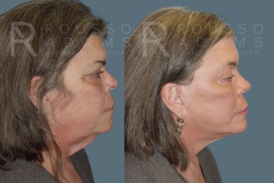 Facelift <span class=small>By Dr. Daniel Rousso</span> Before & After Gallery - Patient 147375108 - Image 2