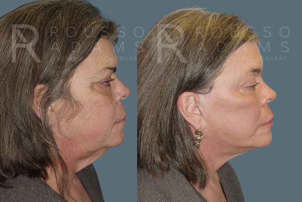 Facelift - Dr. Rousso Before & After Gallery - Patient 147375108 - Image 2