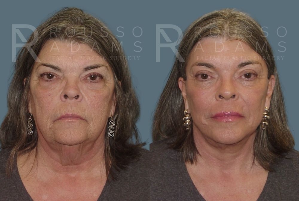 Facelift - Dr. Rousso Before & After Gallery - Patient 147375108 - Image 3