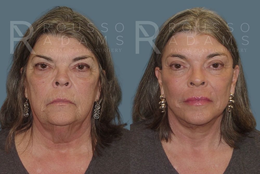 Facelift <span class=small>By Dr. Daniel Rousso</span> Before & After Gallery - Patient 147375108 - Image 3