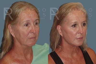 Facelift <span class=small>By Dr. Daniel Rousso</span> Before & After Gallery - Patient 147375109 - Image 1