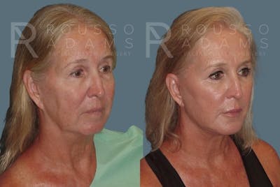 Facelift Before & After Gallery - Patient 147375109 - Image 1