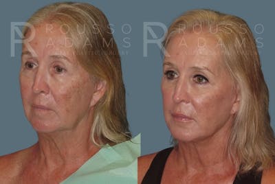 Facelift <span class=small>By Dr. Daniel Rousso</span> Before & After Gallery - Patient 147375109 - Image 2