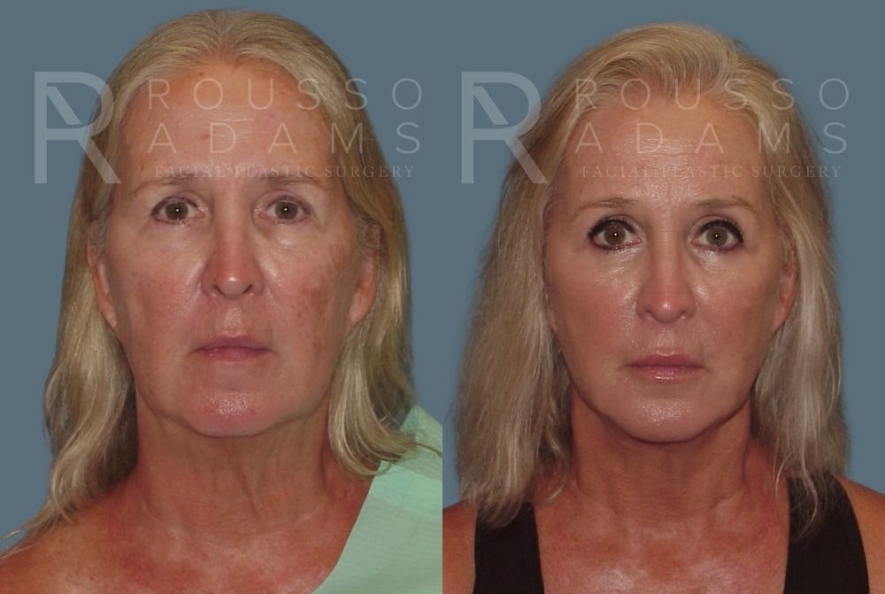 Facelift <span class=small>By Dr. Daniel Rousso</span> Before & After Gallery - Patient 147375109 - Image 3