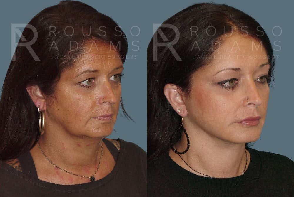 Facelift - Dr. Rousso Before & After Gallery - Patient 147375110 - Image 1