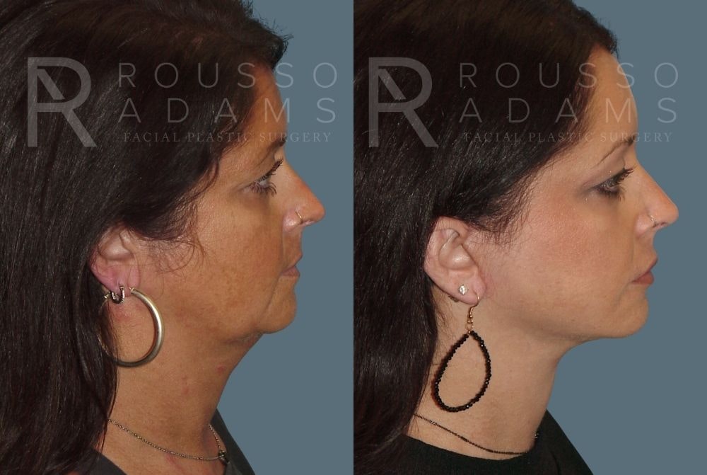 Facelift - Dr. Rousso Before & After Gallery - Patient 147375110 - Image 2