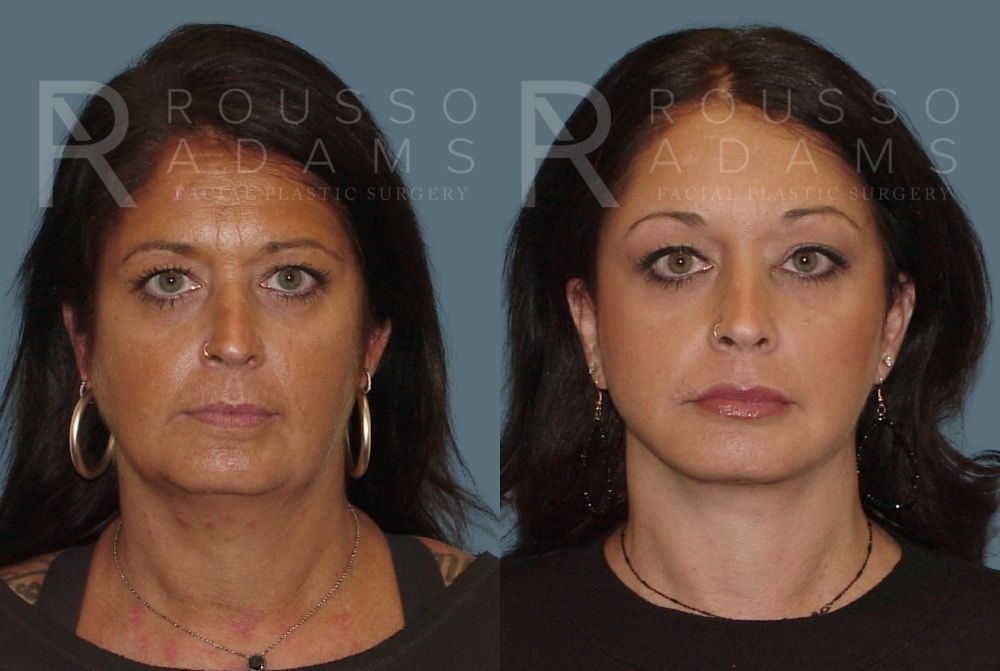 Facelift <span class=small>By Dr. Daniel Rousso</span> Before & After Gallery - Patient 147375110 - Image 3