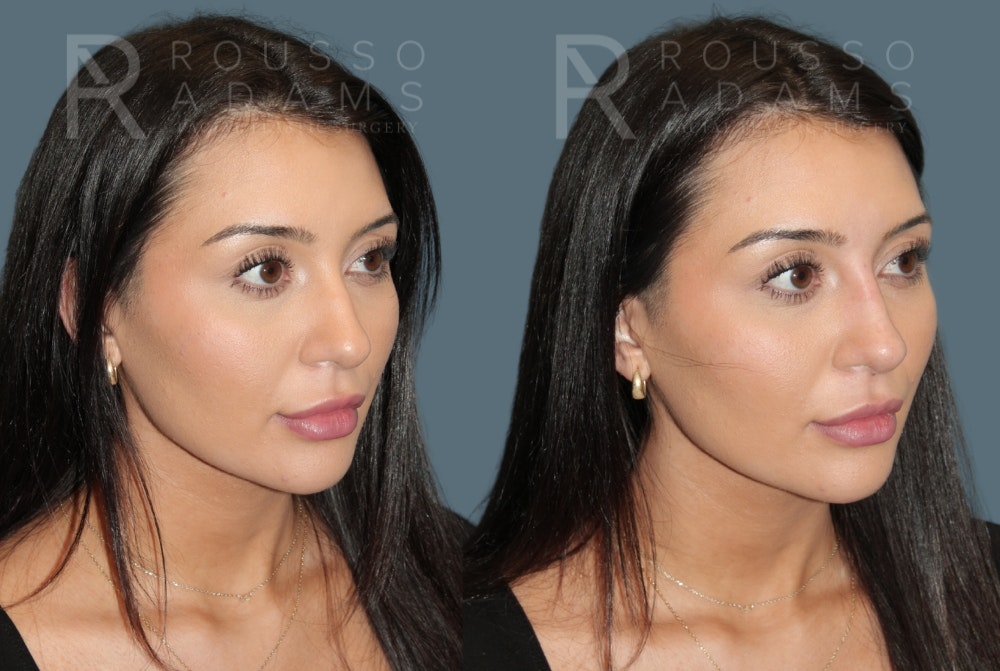 Liquid Rhinoplasty Before & After Gallery - Patient 147392411 - Image 2