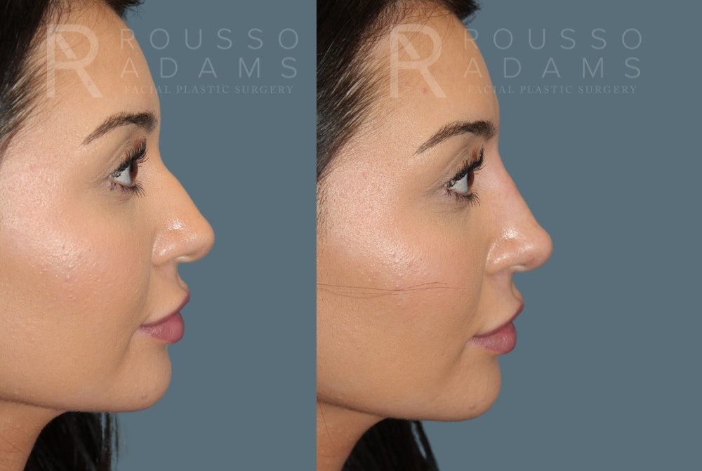 Liquid Rhinoplasty Before & After Gallery - Patient 147392411 - Image 1