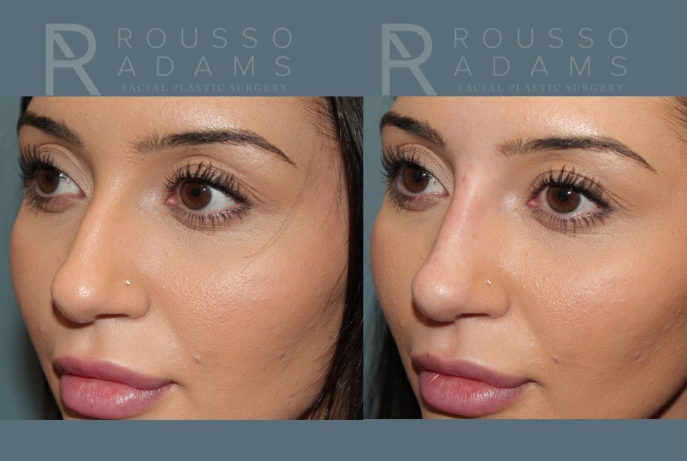 Liquid Rhinoplasty Before & After Gallery - Patient 147392411 - Image 3