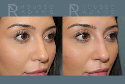 Liquid Rhinoplasty Before & After Gallery - Patient 147392411 - Image 4