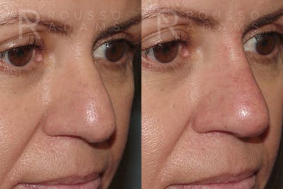 Liquid Rhinoplasty Gallery Before & After Gallery - Patient 147392412 - Image 2
