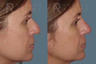Liquid Rhinoplasty Before & After Gallery - Patient 147392412 - Image 1