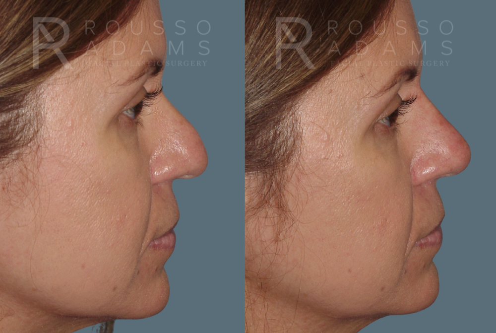 Liquid Rhinoplasty Before & After Gallery - Patient 147392412 - Image 1