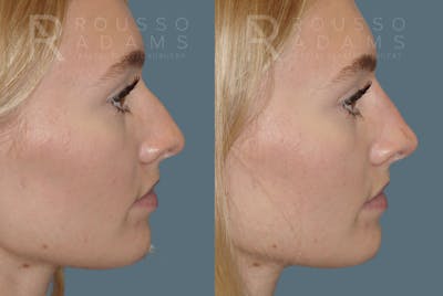 Liquid Rhinoplasty Before & After Gallery - Patient 147392413 - Image 1