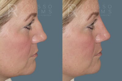 Liquid Rhinoplasty Gallery Before & After Gallery - Patient 147392414 - Image 1