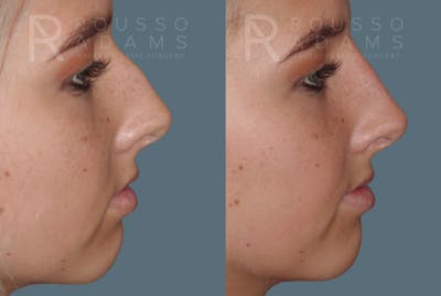 Liquid Rhinoplasty Gallery Before & After Gallery - Patient 147392415 - Image 1