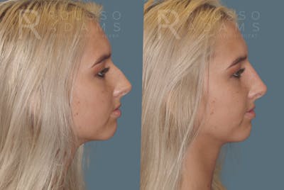 Liquid Rhinoplasty Before & After Gallery - Patient 147392415 - Image 2