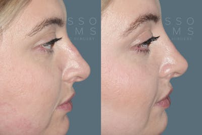 Liquid Rhinoplasty Gallery Before & After Gallery - Patient 147392416 - Image 1