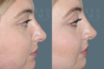 Liquid Rhinoplasty Before & After Gallery - Patient 147392416 - Image 1
