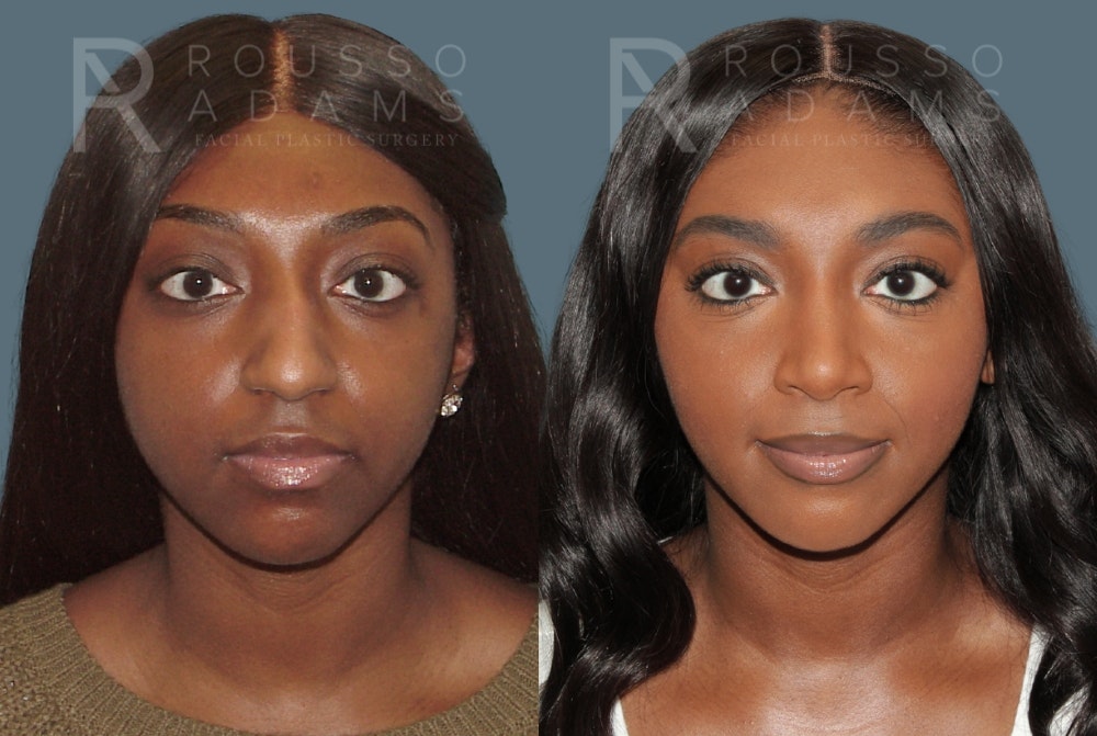 Rhinoplasty <span class=small>By Dr. Daniel Rousso</span> Before & After Gallery - Patient 147392421 - Image 3