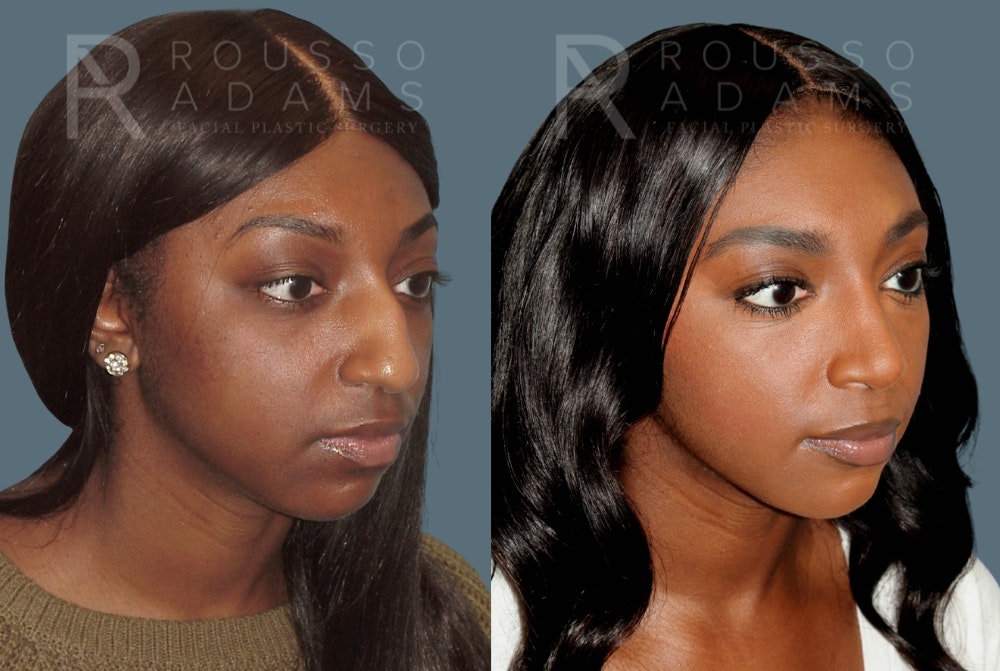 Rhinoplasty Before & After Gallery - Patient 147392421 - Image 2