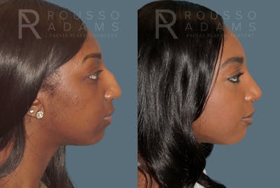 Rhinoplasty Before & After Gallery - Patient 147392421 - Image 1