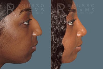 Rhinoplasty Before & After Gallery - Patient 147392421 - Image 4