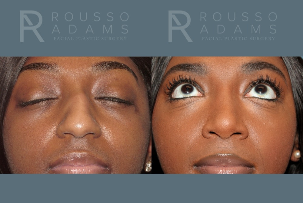 Rhinoplasty Before & After Gallery - Patient 147392421 - Image 5