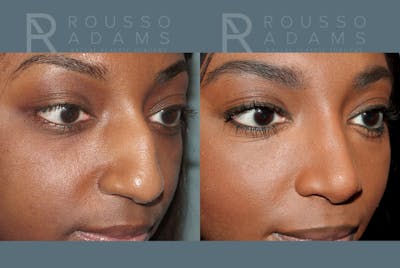 Rhinoplasty Before & After Gallery - Patient 147392421 - Image 6