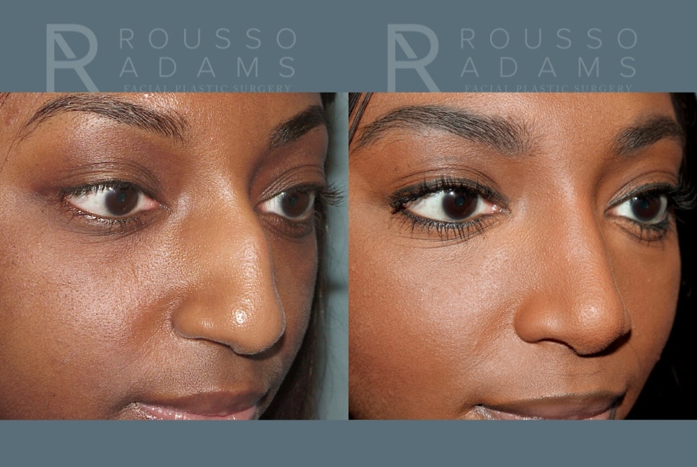 Rhinoplasty <span class=small>By Dr. Daniel Rousso</span> Before & After Gallery - Patient 147392421 - Image 6