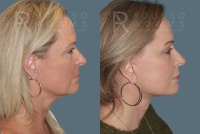 Facelift Before & After Gallery - Patient 147416837 - Image 2