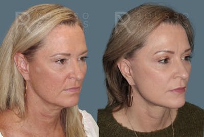 Facelift Before & After Gallery - Patient 147416837 - Image 1
