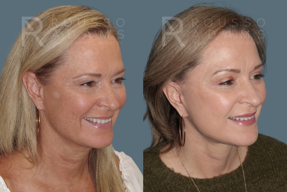 Facelift Before & After Gallery - Patient 147416837 - Image 3
