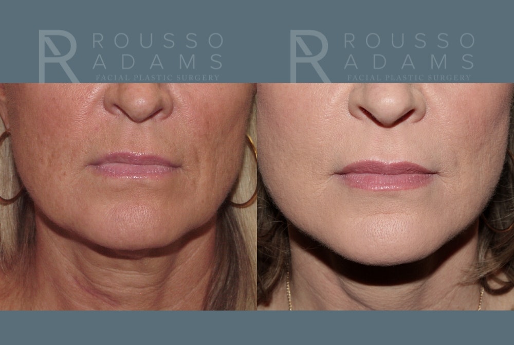 Facelift Before & After Gallery - Patient 147416837 - Image 4