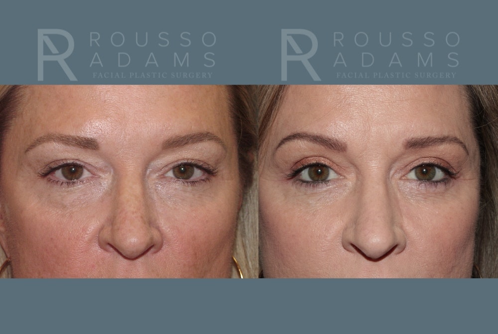 Facelift Before & After Gallery - Patient 147416837 - Image 5