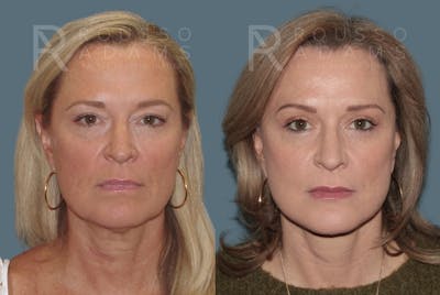 Facelift Before & After Gallery - Patient 147416837 - Image 6