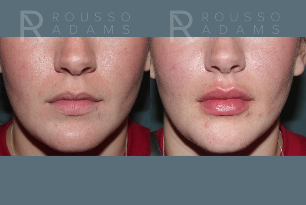 Lip Enhancement Before & After Gallery - Patient 147739010 - Image 1