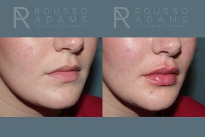 Lip Enhancement Before & After Gallery - Patient 147739010 - Image 2