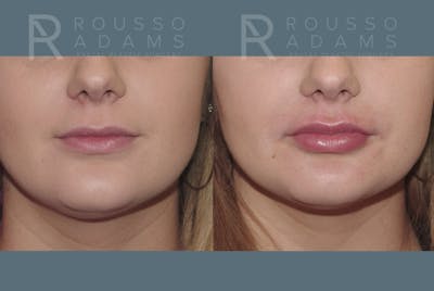 Lip Enhancement Before & After Gallery - Patient 147739031 - Image 1