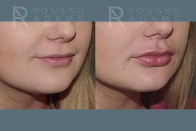 Lip Enhancement Before & After Gallery - Patient 147739031 - Image 2