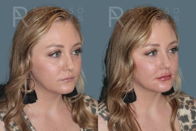 Lip Enhancement Before & After Gallery - Patient 147739030 - Image 4