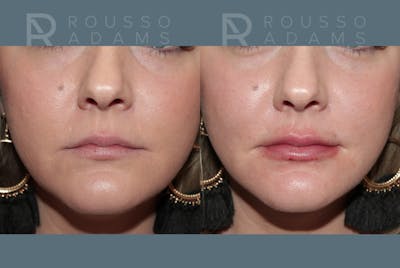 Lip Enhancement Before & After Gallery - Patient 147739030 - Image 1