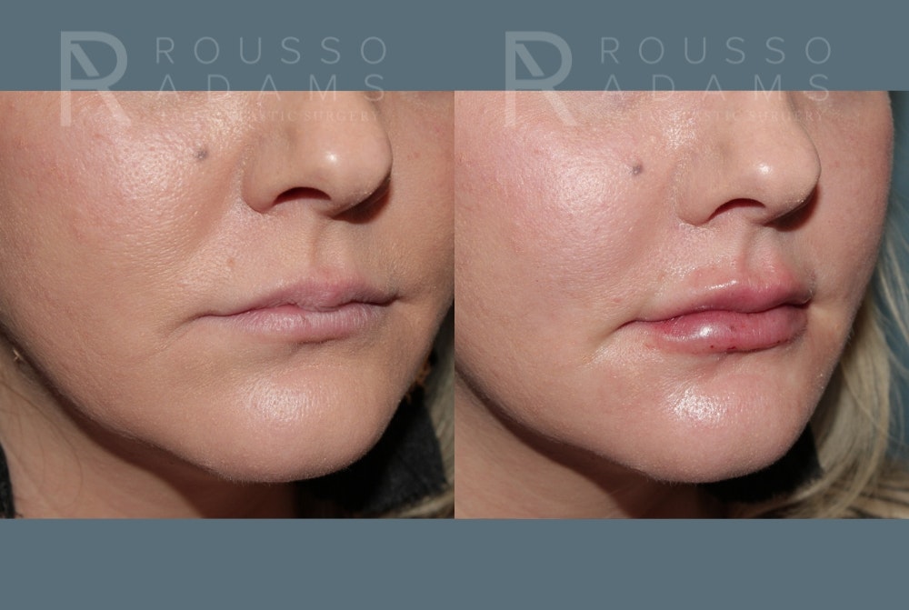 Lip Enhancement Before & After Gallery - Patient 147739030 - Image 2
