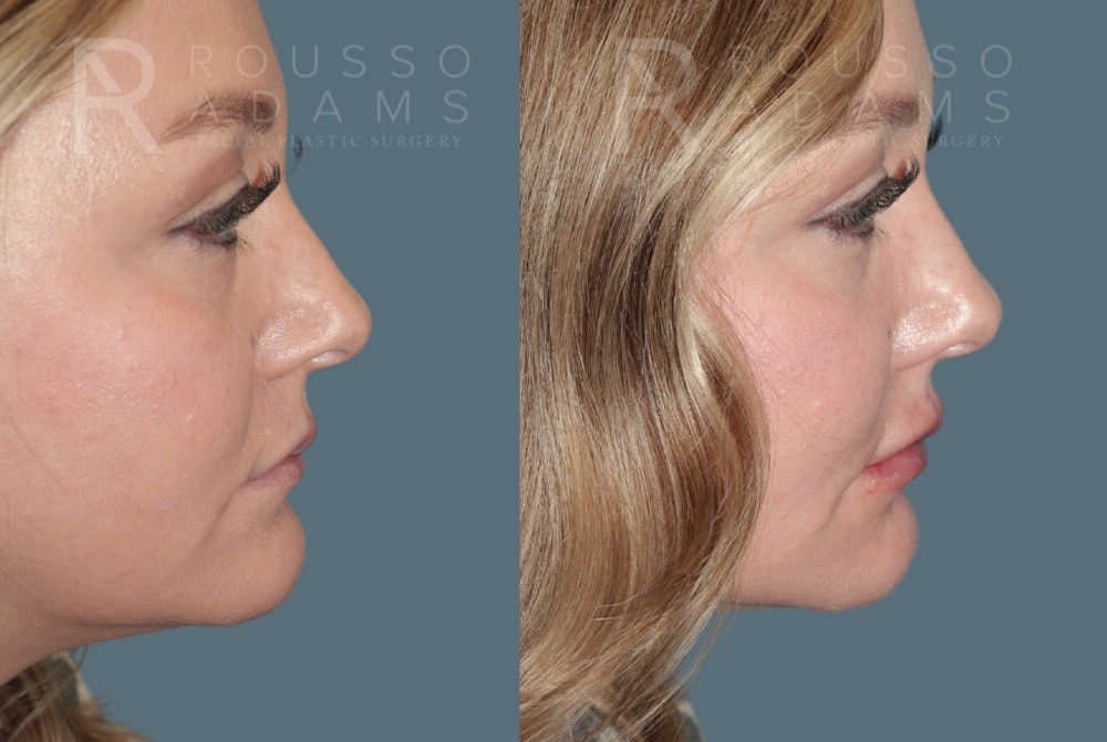 Lip Enhancement Before & After Gallery - Patient 147739030 - Image 5