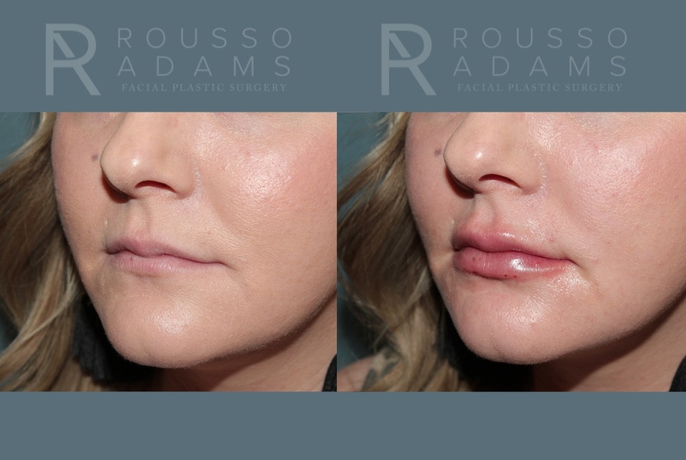 Lip Enhancement Before & After Gallery - Patient 147739030 - Image 3